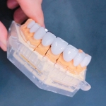 Ưu việt của sứ Cercon – Phục hình toàn sứ Zirconia