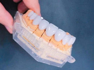 Ưu việt của sứ Cercon – Phục hình toàn sứ Zirconia