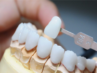 PHỤC HÌNH RĂNG XỨ TITAN