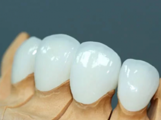 PHỤC HÌNH RĂNG SỨ LAVA